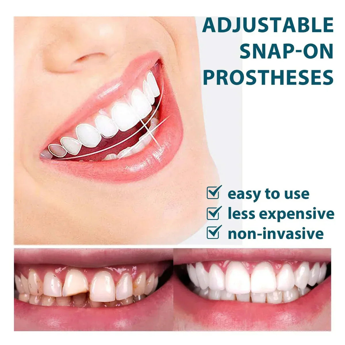 Zavinox™ Adjustable Snap-On Dentures
