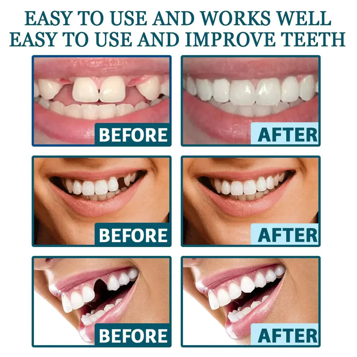 Zavinox™ Adjustable Snap-On Dentures
