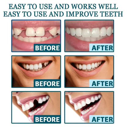 Zavinox™ Adjustable Snap-On Dentures